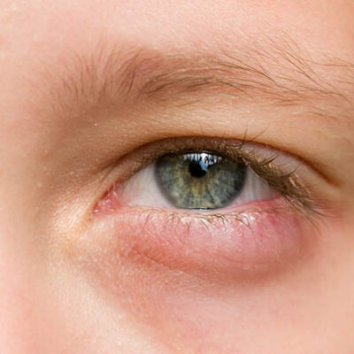 Swollen-Eyelid